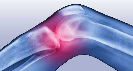 homeo medicine for arthritis