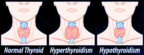 Thyroid