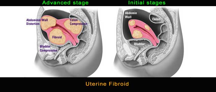 Homeopathy for fibroids treatment 