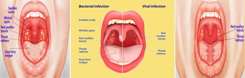 Tonsillitis homeopathy