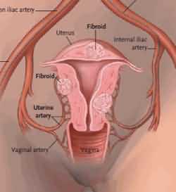 fibroids