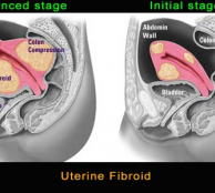 Homeopathy for fibroids treatment 